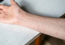 Sarampión en México supera 9 mil casos y 29 muertes